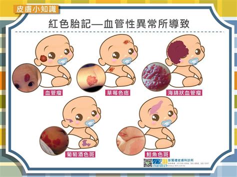 背上有胎記|認識胎記的種類與治療照顧